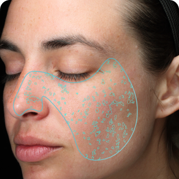 VISIA 7 à Lausanne - Analyse des taches VISIA 7 à Lausanne - Analyse des taches