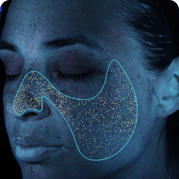 VISIA 7 à Lausanne - Analyse des porphyrines